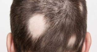 Pacientes com Alopecia Areata contam trajetória para reaver autoestima.